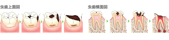 虫歯の病態図